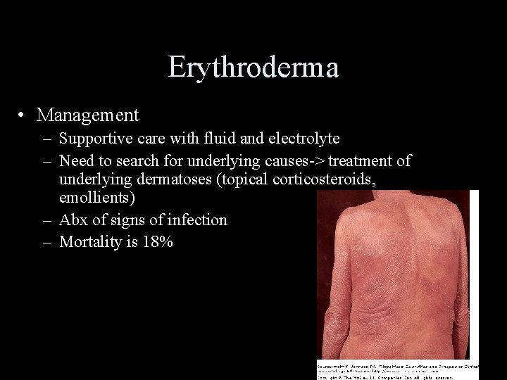 Erythroderma • Management – Supportive care with fluid and electrolyte – Need to search