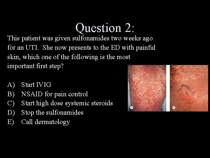 Question 2: This patient was given sulfonamides two weeks ago for an UTI. She