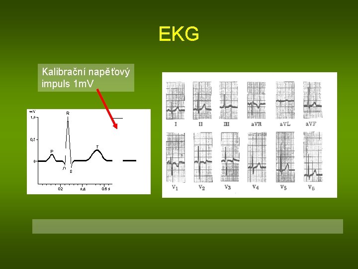 EKG Kalibrační napěťový impuls 1 m. V 