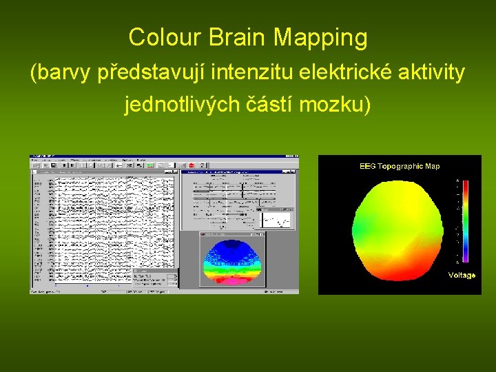 Colour Brain Mapping (barvy představují intenzitu elektrické aktivity jednotlivých částí mozku) 