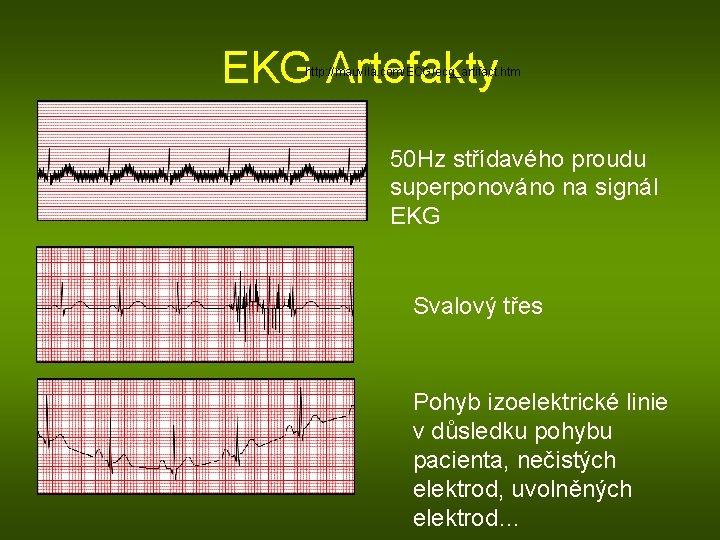 EKG Artefakty http: //mauvila. com/ECG/ecg_artifact. htm 50 Hz střídavého proudu superponováno na signál EKG