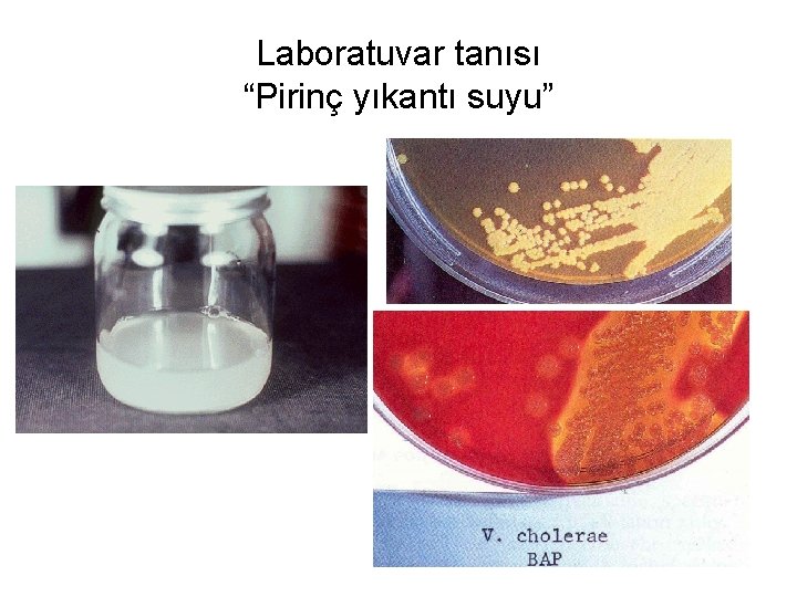 Laboratuvar tanısı “Pirinç yıkantı suyu” 