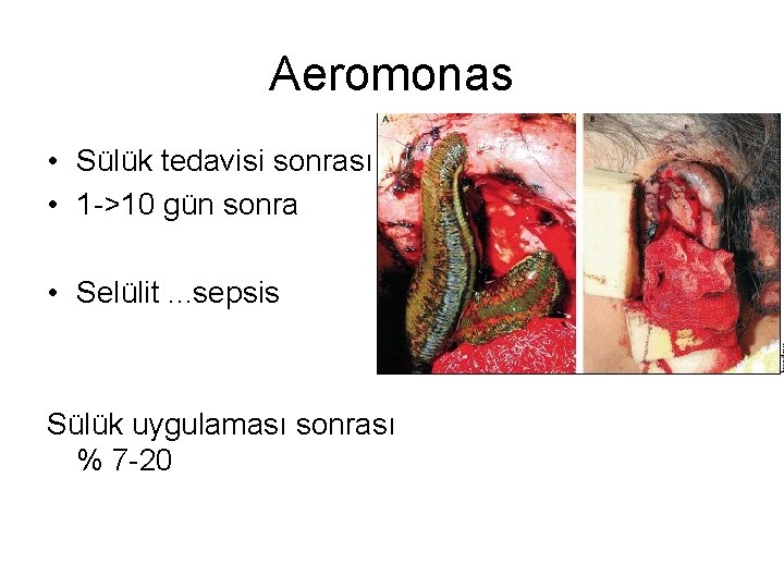 Aeromonas • Sülük tedavisi sonrası • 1 ->10 gün sonra • Selülit. . .