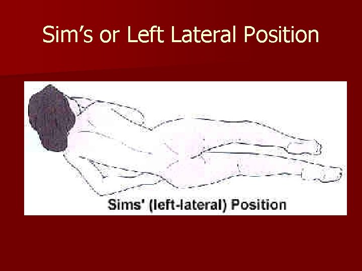 Sim’s or Left Lateral Position 