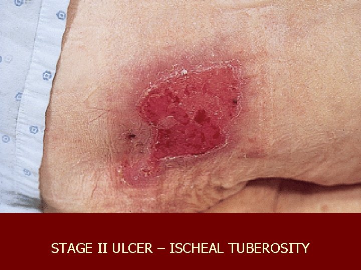 STAGE II ULCER – ISCHEAL TUBEROSITY 