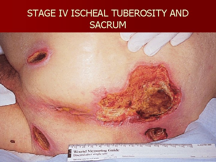 STAGE IV ISCHEAL TUBEROSITY AND SACRUM 