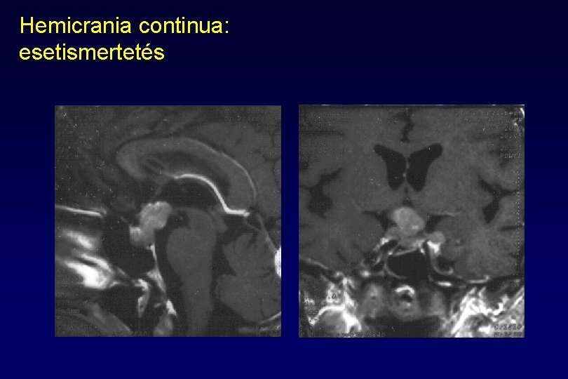 Hemicrania continua: esetismertetés Hemicrania continua: esetismertetés