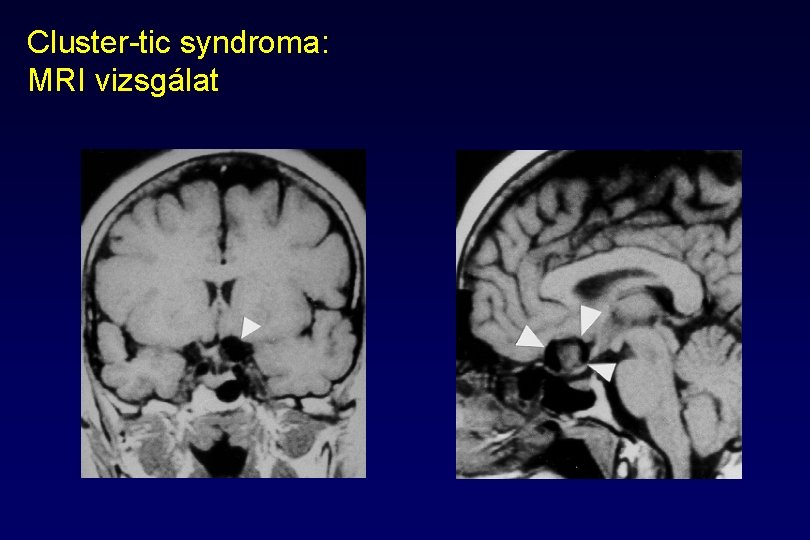 Cluster-tic syndroma: MRI vizsgálat Cluster-tic syndroma: MRI vizsgálat