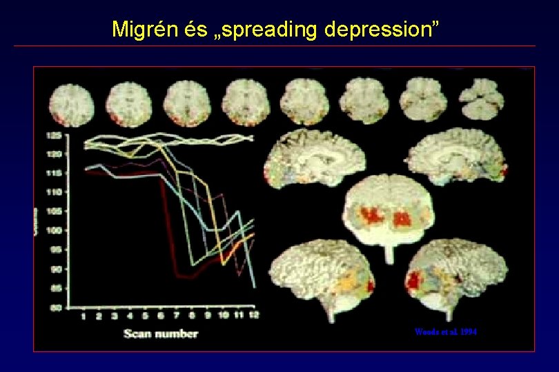 Migrén és „spreading depression” Woods et al. 1994 Migrén és „spreading depression” Woods et al. 1994