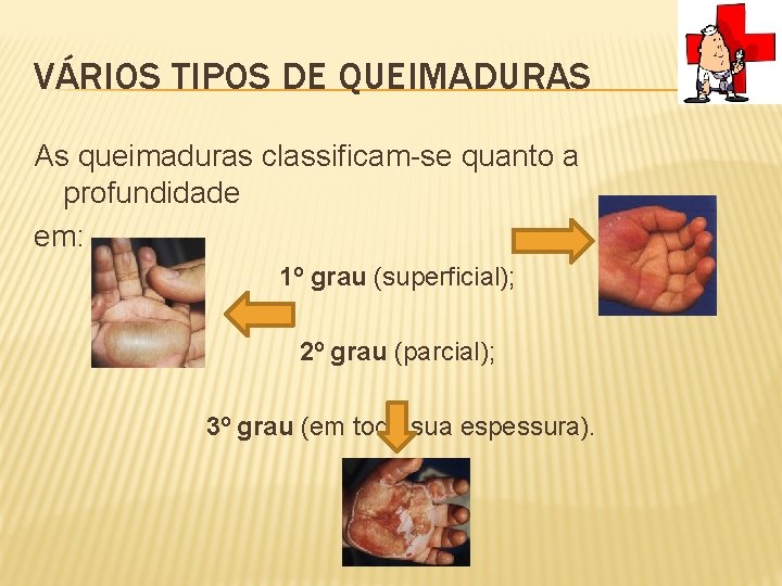 VÁRIOS TIPOS DE QUEIMADURAS As queimaduras classificam-se quanto a profundidade em: 1º grau (superficial);