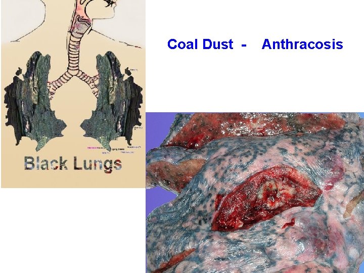 Coal Dust - Anthracosis 