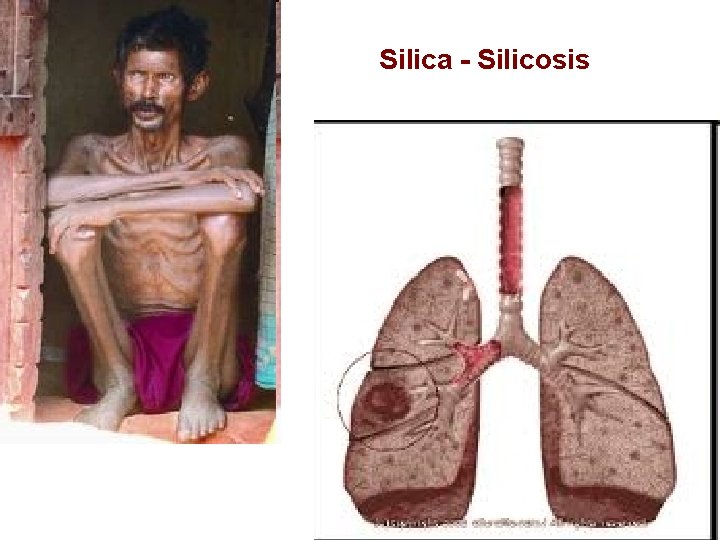 Silica - Silicosis 