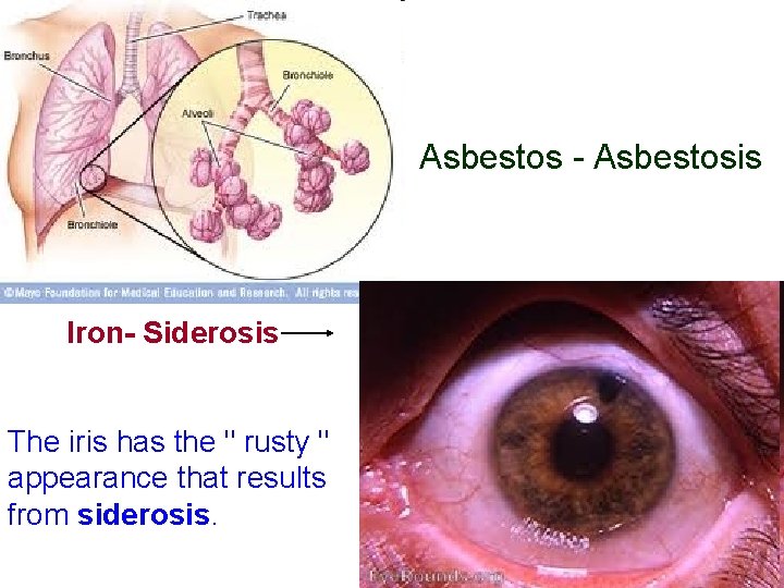 Asbestos - Asbestosis Iron- Siderosis The iris has the " rusty " appearance that
