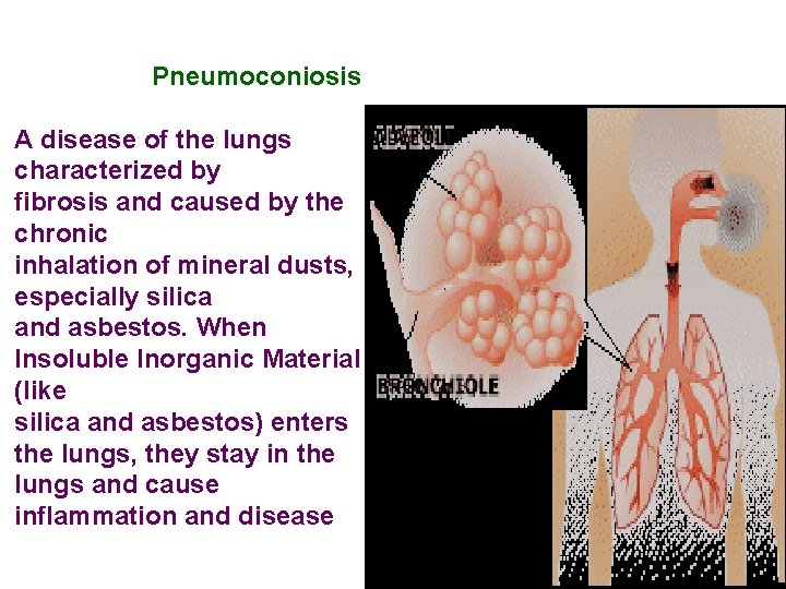  Pneumoconiosis A disease of the lungs characterized by fibrosis and caused by the
