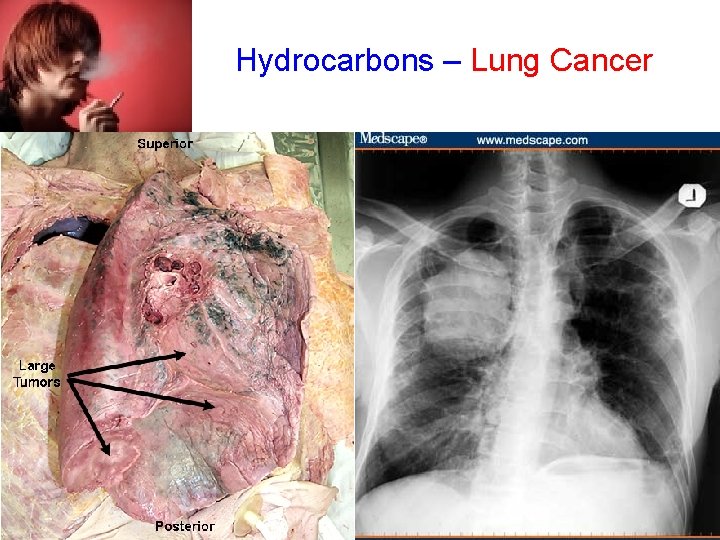 Hydrocarbons – Lung Cancer 