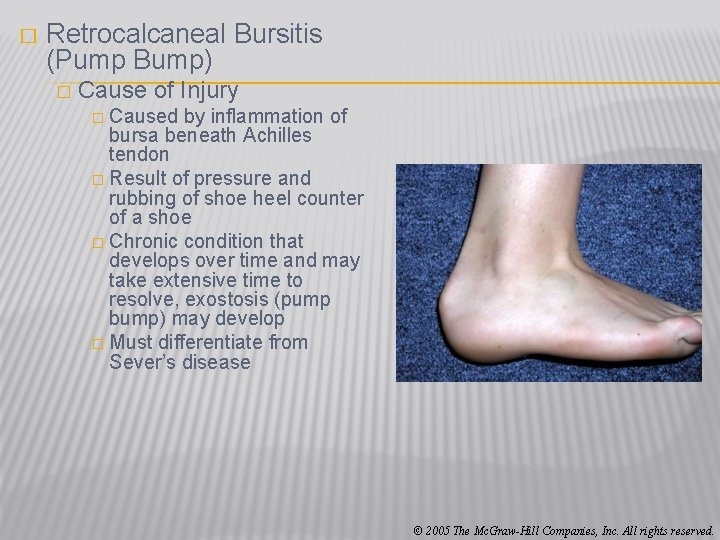 � Retrocalcaneal Bursitis (Pump Bump) � Cause of Injury � Caused by inflammation of
