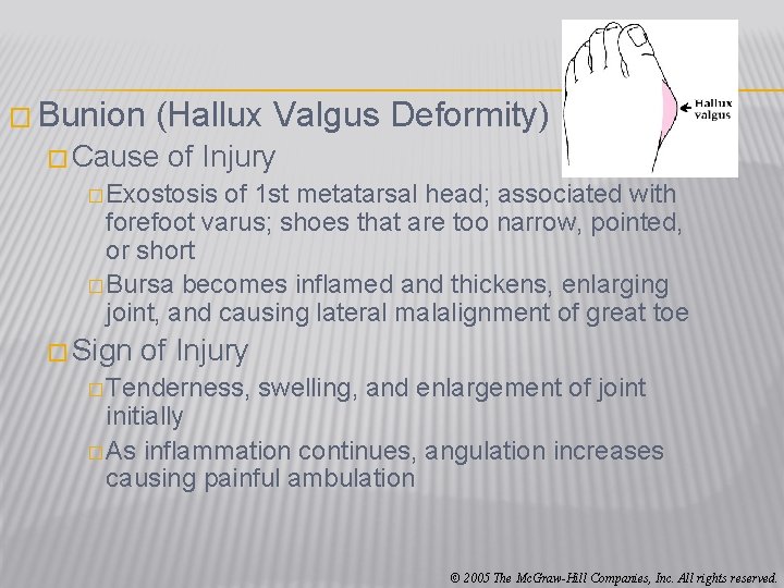 � Bunion (Hallux Valgus Deformity) � Cause of Injury � Exostosis of 1 st