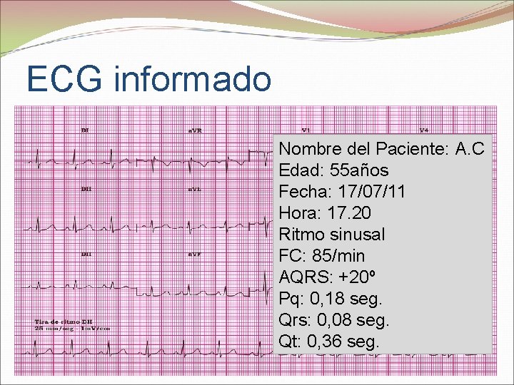 ECG informado Nombre del Paciente: A. C Edad: 55 años Fecha: 17/07/11 Hora: 17.