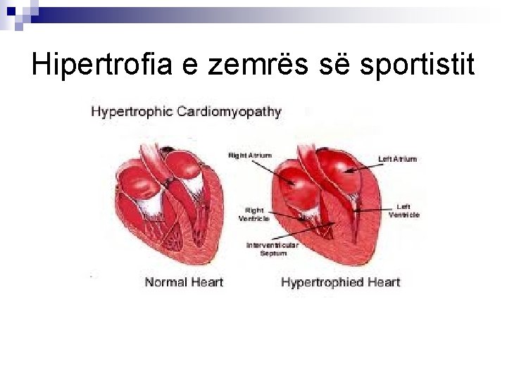 Hipertrofia e zemrës së sportistit 