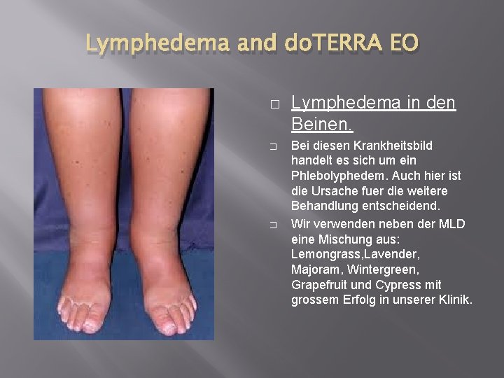 Lymphedema and do. TERRA EO � � � Lymphedema in den Beinen. Bei diesen