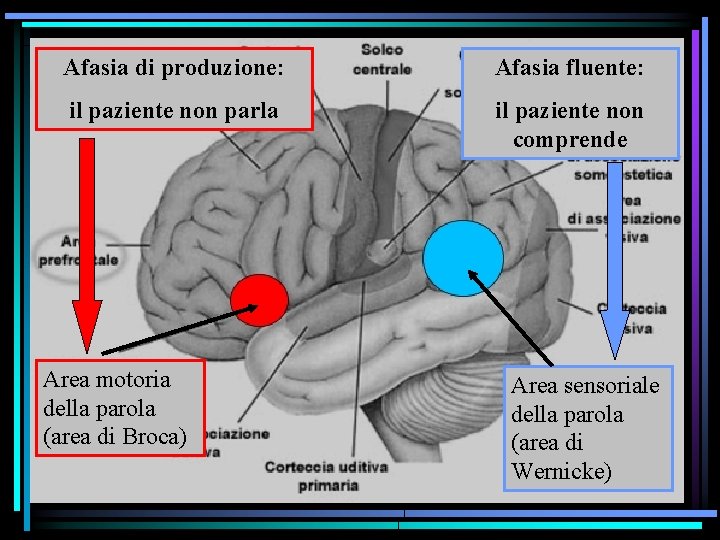 Afasia didegli produzione: fluente: Studio effetti di lesioni. Afasia cerebrali il paziente non parla