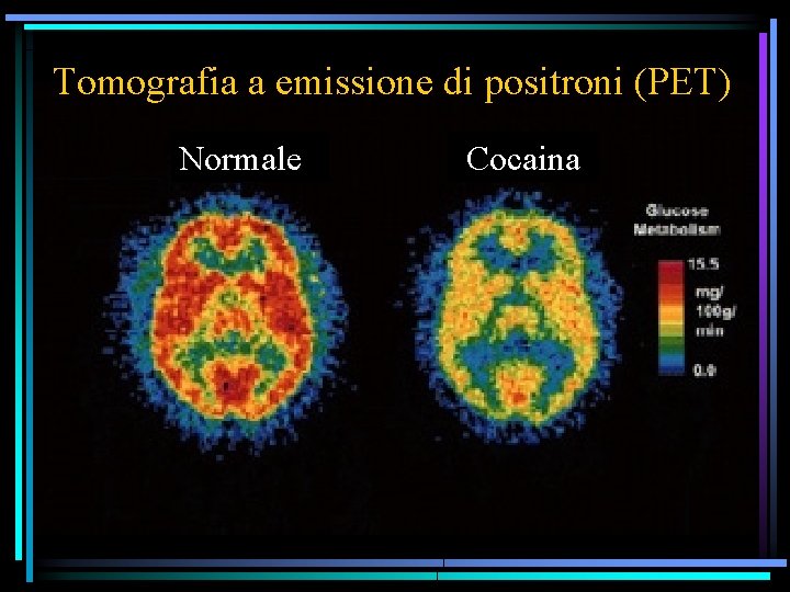 Tomografia a emissione di positroni (PET) Normale Cocaina 
