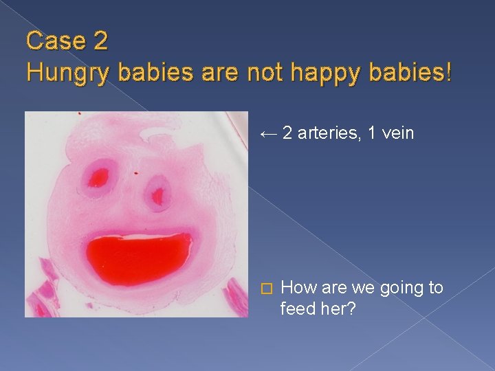 Case 2 Hungry babies are not happy babies! ← 2 arteries, 1 vein �