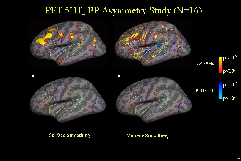 PET 5 HT 4 BP Asymmetry Study (N=16) p<10 -3 Left > Right p<10