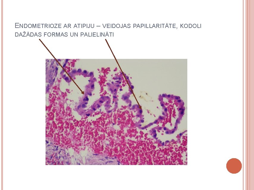 ENDOMETRIOZE AR ATIPIJU – VEIDOJAS PAPILLARITĀTE, KODOLI DAŽĀDAS FORMAS UN PALIELINĀTI 