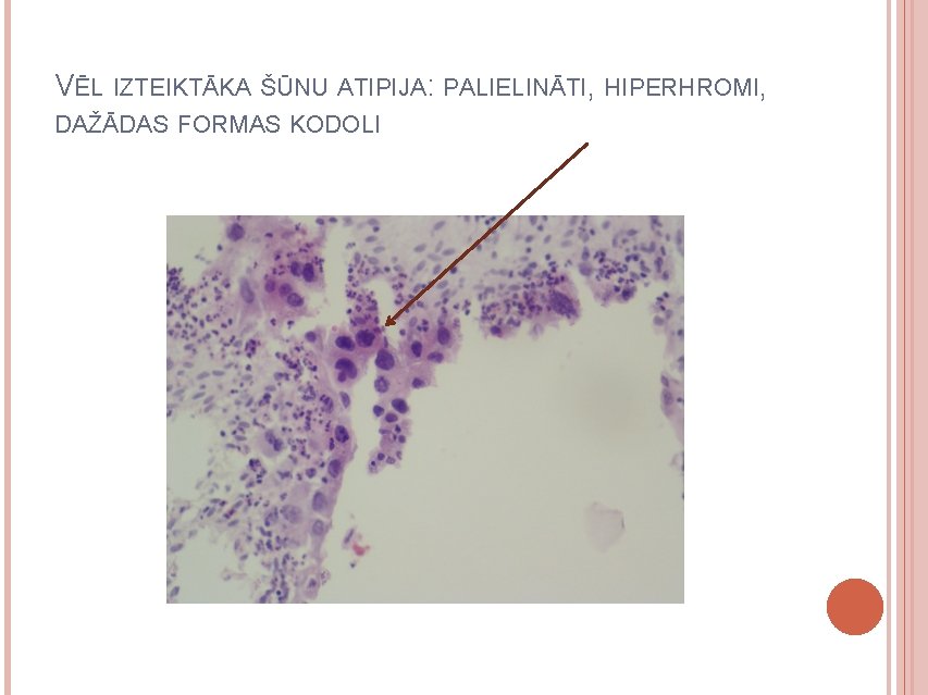 VĒL IZTEIKTĀKA ŠŪNU ATIPIJA: PALIELINĀTI, HIPERHROMI, DAŽĀDAS FORMAS KODOLI 