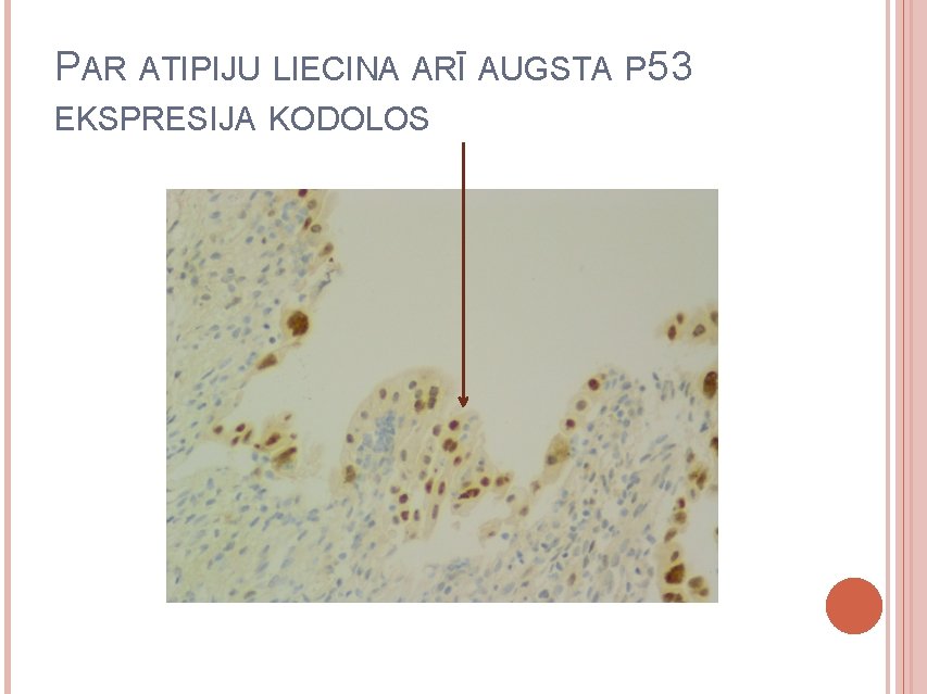 PAR ATIPIJU LIECINA ARĪ AUGSTA P 53 EKSPRESIJA KODOLOS 