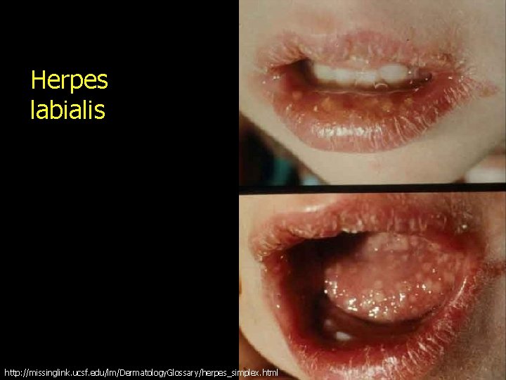 Herpes labialis http: //missinglink. ucsf. edu/lm/Dermatology. Glossary/herpes_simplex. html 