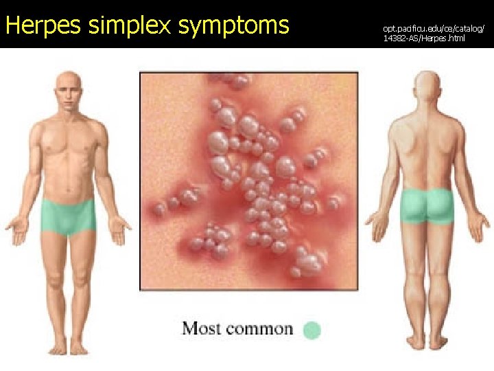 Herpes simplex symptoms opt. pacificu. edu/ce/catalog/ 14382 -AS/Herpes. html 