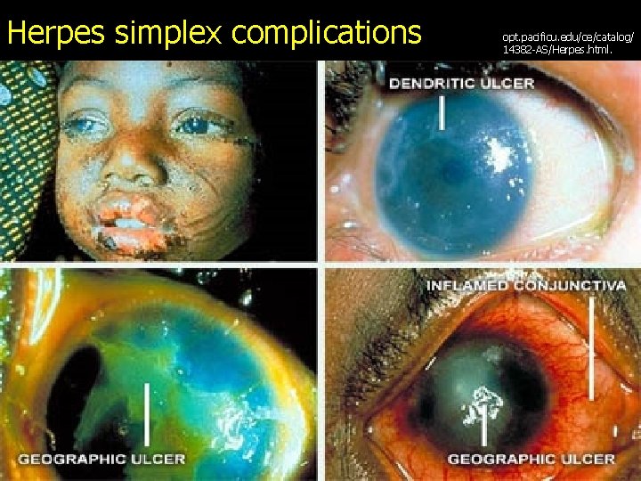 Herpes simplex complications opt. pacificu. edu/ce/catalog/ 14382 -AS/Herpes. html. 