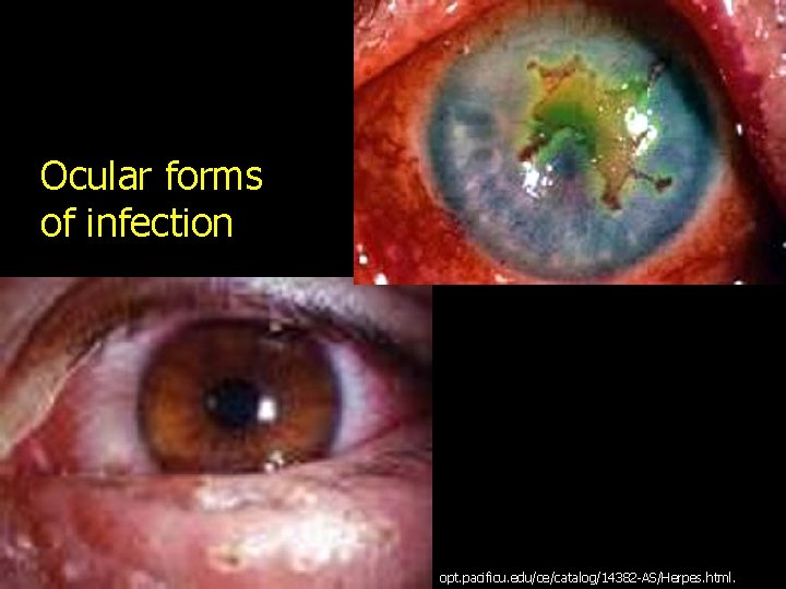 Ocular forms of infection opt. pacificu. edu/ce/catalog/14382 -AS/Herpes. html. 