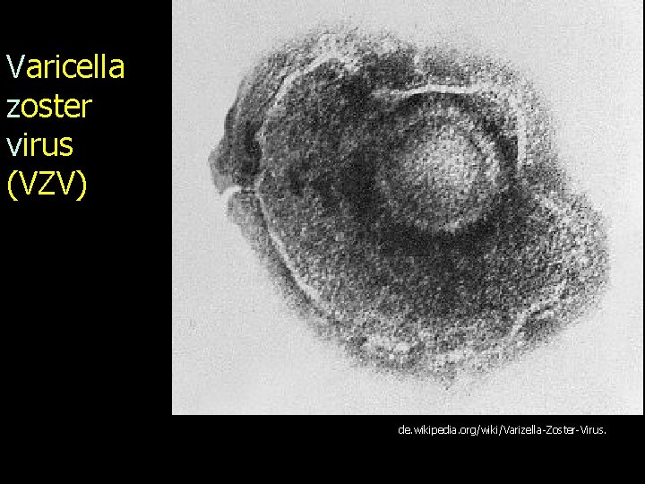 Varicella zoster virus (VZV) de. wikipedia. org/wiki/Varizella-Zoster-Virus. 