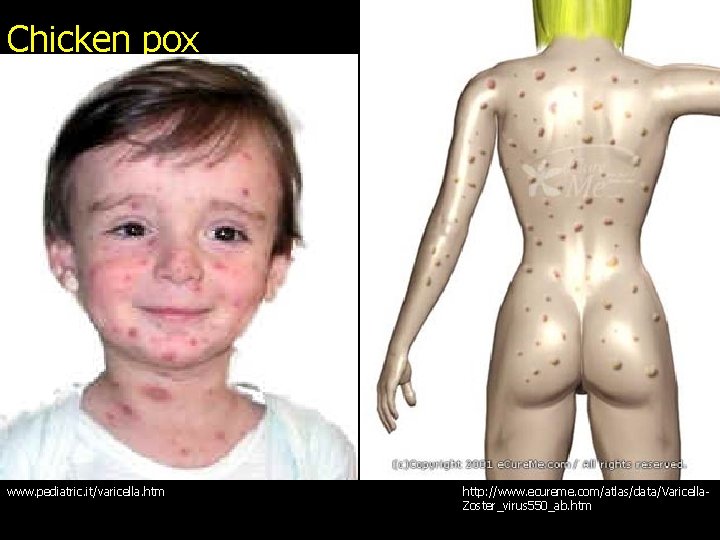 Chicken pox www. pediatric. it/varicella. htm http: //www. ecureme. com/atlas/data/Varicella. Zoster_virus 550_ab. htm 