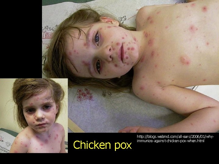 Chicken pox http: //blogs. webmd. com/all-ears/2006/01/whyimmunize-against-chicken-pox-when. html 