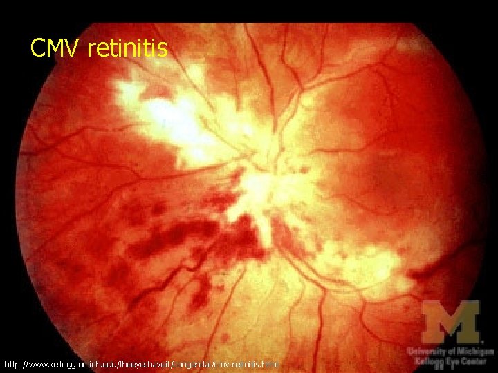 CMV retinitis http: //www. kellogg. umich. edu/theeyeshaveit/congenital/cmv-retinitis. html 