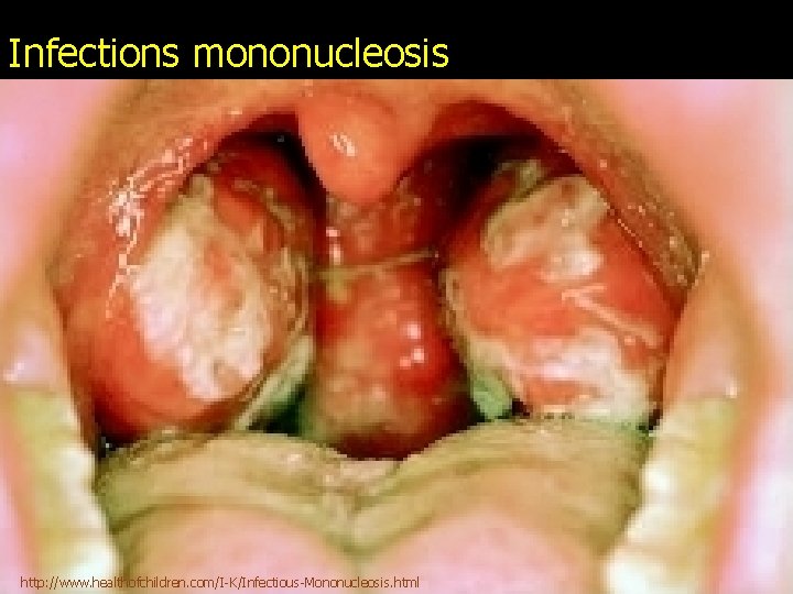 Infections mononucleosis http: //www. healthofchildren. com/I-K/Infectious-Mononucleosis. html 