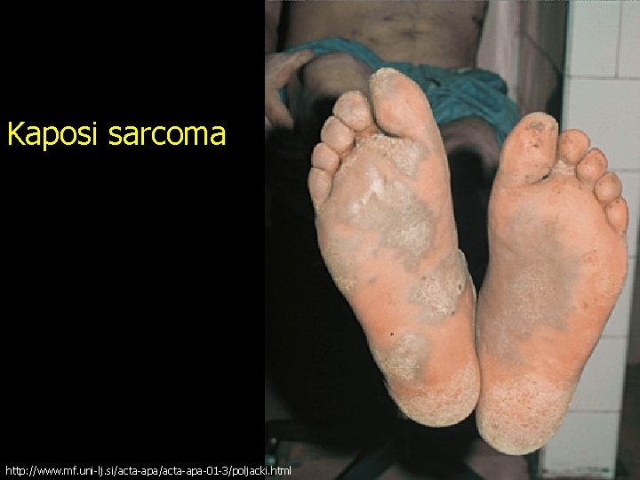 Kaposi sarcoma http: //www. mf. uni-lj. si/acta-apa-01 -3/poljacki. html 