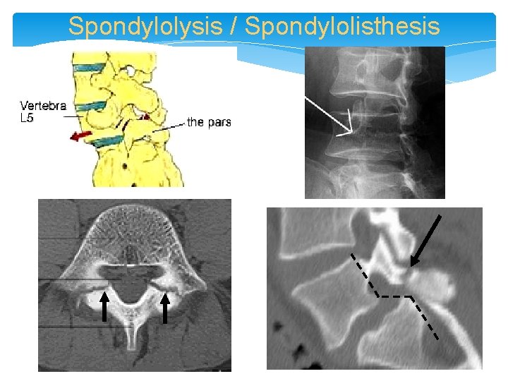 Spondylolysis / Spondylolisthesis 