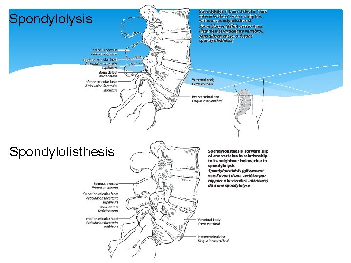 Spondylolysis Spondylolisthesis 