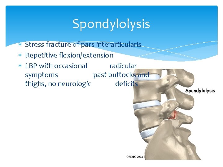 Spondylolysis Stress fracture of pars interarticularis Repetitive flexion/extension LBP with occasional radicular symptoms past
