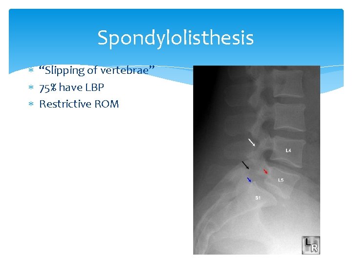 Spondylolisthesis “Slipping of vertebrae” 75% have LBP Restrictive ROM 