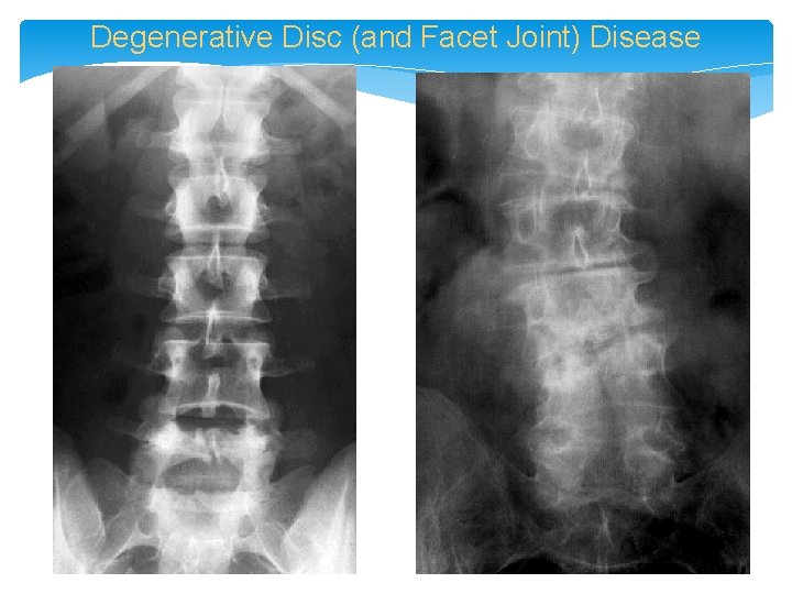 Degenerative Disc (and Facet Joint) Disease 