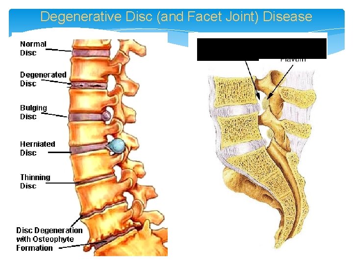 Degenerative Disc (and Facet Joint) Disease Foraminal stenosis Thickening/Buckling of Ligamentum Flavum 
