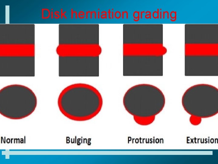 Disk herniation grading 