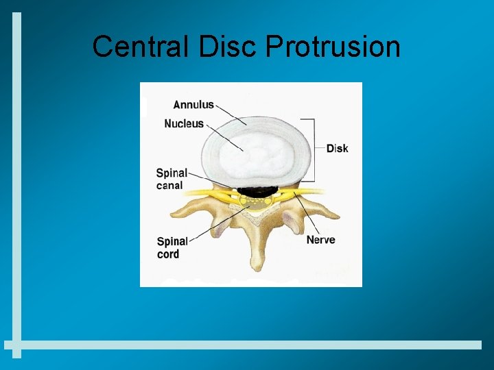 Central Disc Protrusion 