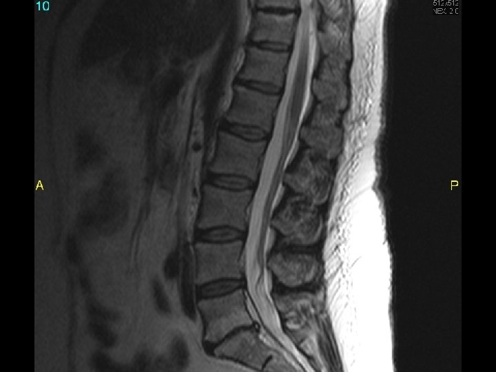 MRI scan slide #3 